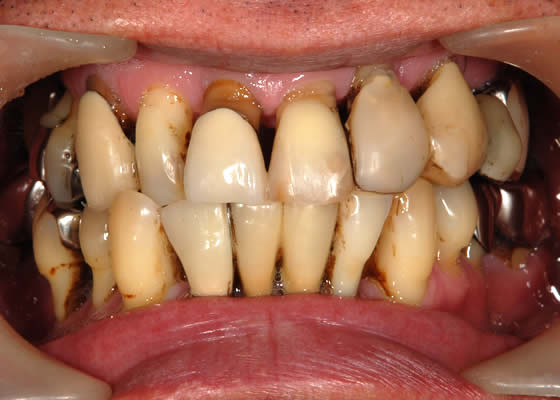 歯 が ボロボロ に なる 原因