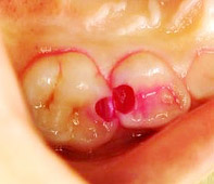虫歯の進行状況別の治療内容